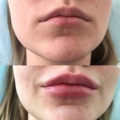 Отзыв о Оригитея клиника доктора Мухиной: Корекция губ